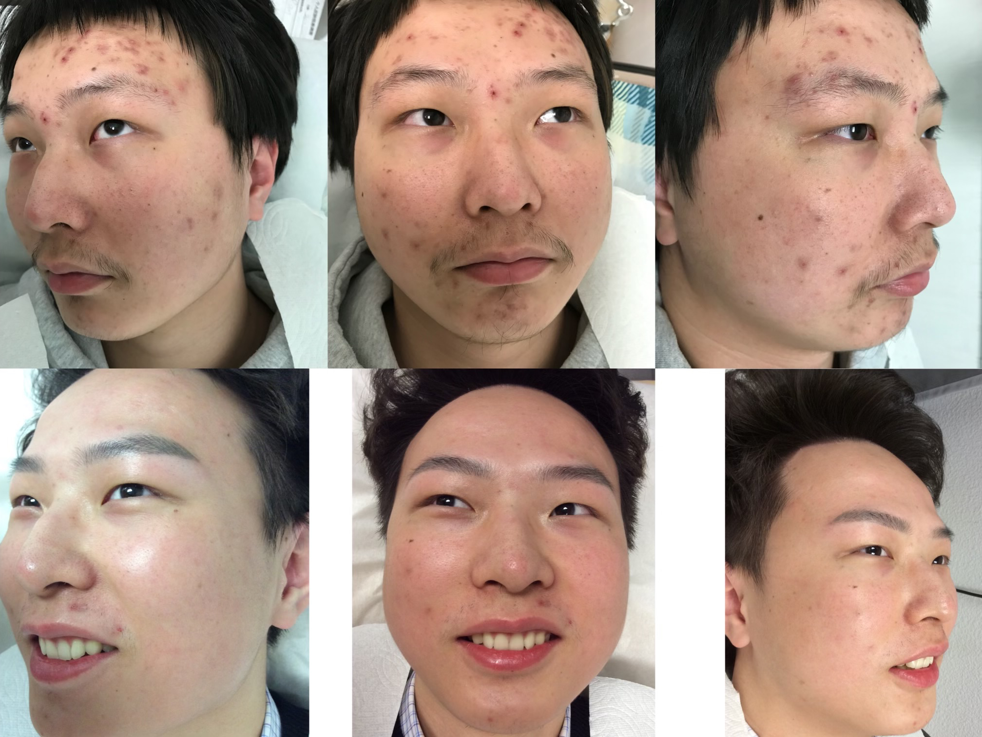 Transformación de acné de paciente - antes y después de 6 meses de tratamiento en Daisy MD Care